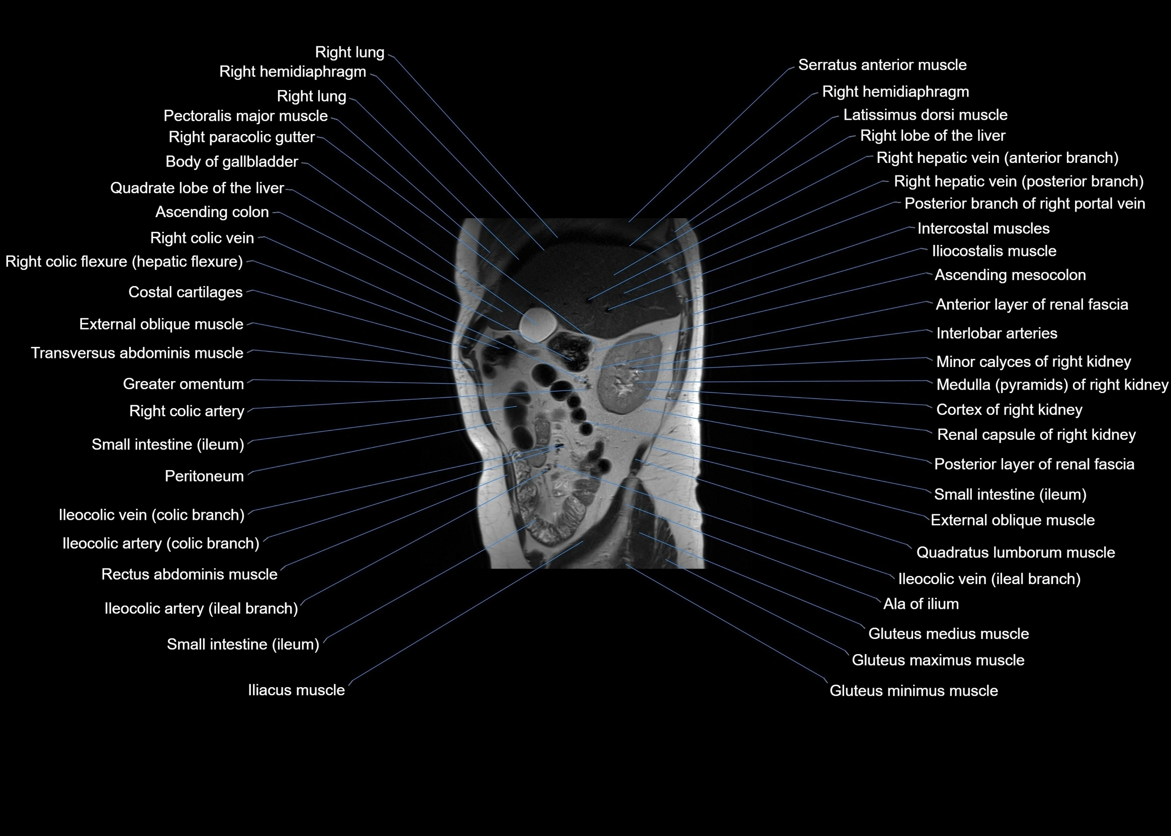 MRI abdomen sagittal cross sectional anatomy  radiology  image-img-00001-00021.webp